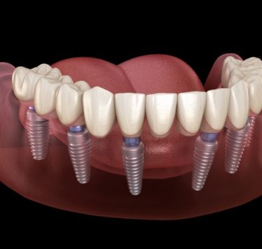 Treatment - All-on-Four/All-on-Six Same Day Teeth