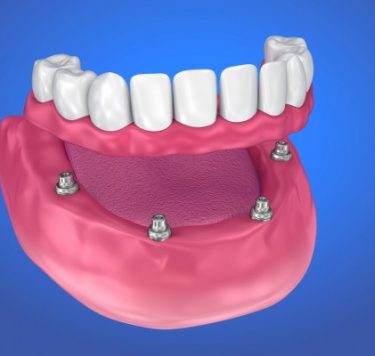 Treatment - Implant-Retained Dentures