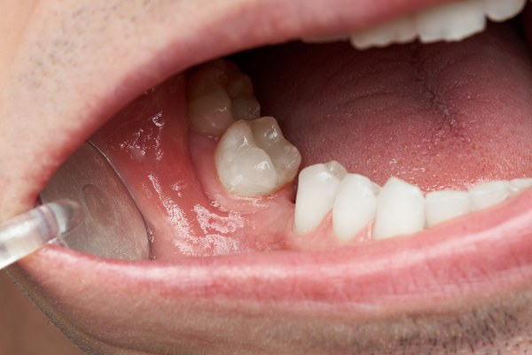 teeth missing dentures
