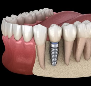 Treatment - Single Tooth Dental Implants