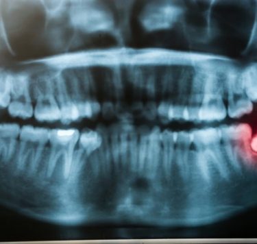 Treatment - Tooth Extraction