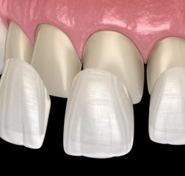 Treatment - Veneers